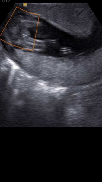 Bild zu Outing in der 17. ssw - Schwanger - wer noch? Rund um die Schwangerschaft