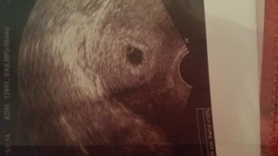 Bild zu nur dottersack zu sehen! - Schwanger - wer noch? Rund um die Schwangerschaft