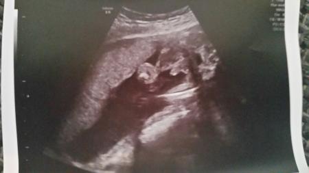 Bild zu Eindeutiges Jungen-Outing - Schwanger - wer noch? Rund um die Schwangerschaft