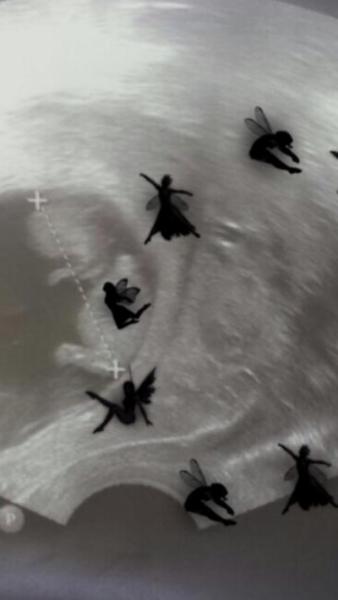 Bild zu Sind es Zwillinge oder nicht? - Schwanger - wer noch? Rund um die Schwangerschaft