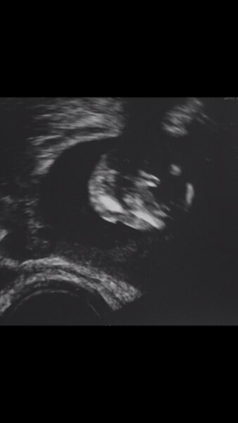 Bild zu Könnt ihr was erkenne mädels ? - Schwanger - wer noch? Rund um die Schwangerschaft