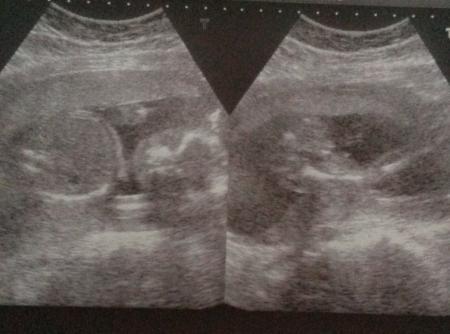 Bild zu Ultraschallbild - Schwanger - wer noch? Rund um die Schwangerschaft