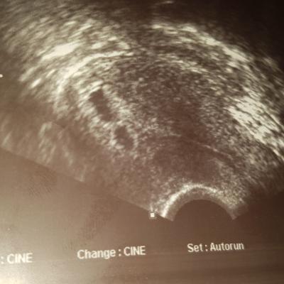 Bild zu 2 Fruchthöllen 1 Dottersack - Schwanger - wer noch? Rund um die Schwangerschaft