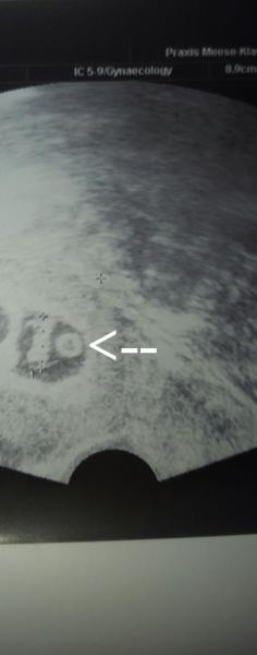 Bild zu Was ist das - Schwanger - wer noch? Rund um die Schwangerschaft