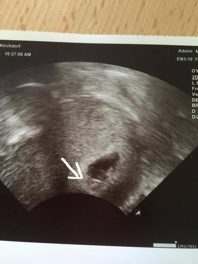 Bild zu Ist da ein zweites Baby??? - Schwanger - wer noch? Rund um die Schwangerschaft