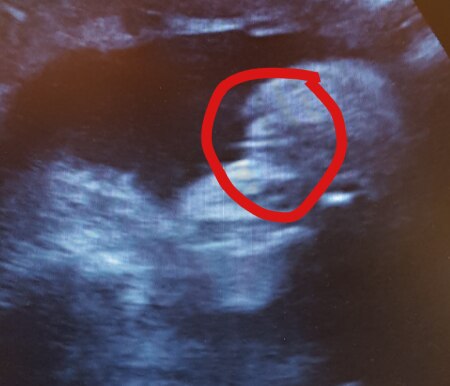 Bild zu Outing 25+4 ssw - Schwanger - wer noch? Rund um die Schwangerschaft