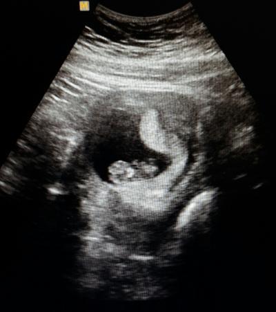 Bild zu Schlage im Bauch ;)? US Profis sind gefragt - Schwanger - wer noch? Rund um die Schwangerschaft