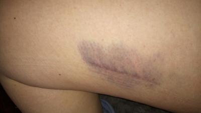 Bild zu Thrombose? - Schwanger - wer noch? Rund um die Schwangerschaft