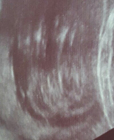 Bild zu Ultraschalbild mädchen oder junge? - Schwanger - wer noch? Rund um die Schwangerschaft