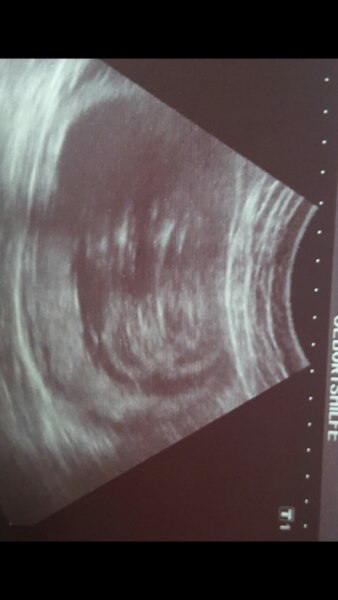 Bild zu Ultraschalbild mädchen oder junge? - Schwanger - wer noch? Rund um die Schwangerschaft