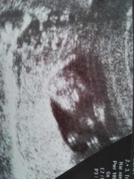 Bild zu Ssw 12 ,Mädchen or junge - Schwanger - wer noch? Rund um die Schwangerschaft