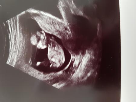 Bild zu Nub Theorie erkennt ihr etwas? - Schwanger - wer noch? Rund um die Schwangerschaft