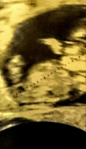 Bild zu Erkennt jemand vielleicht das Geschlecht? - Schwanger - wer noch? Rund um die Schwangerschaft