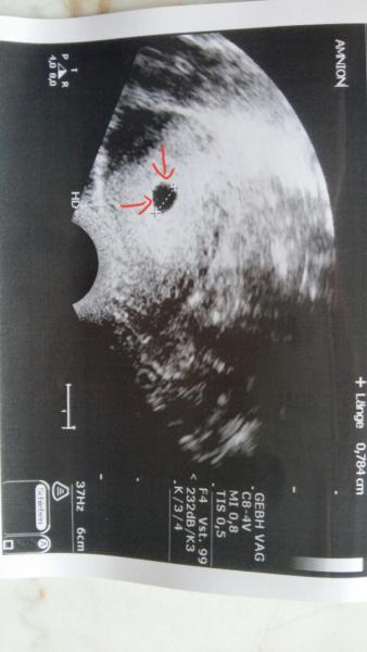 Bild zu Was ist das auf dem Bild.. - Schwanger - wer noch? Rund um die Schwangerschaft