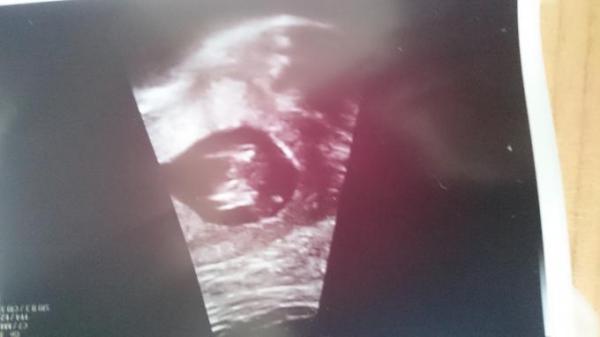 Bild zu Heute ein jungen outing bekommen!? - Schwanger - wer noch? Rund um die Schwangerschaft