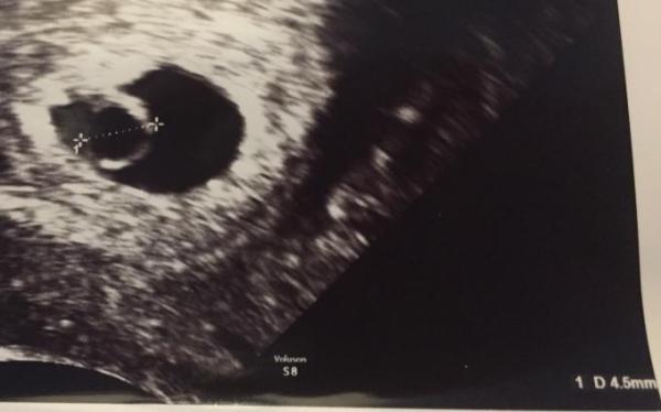 Bild zu Ab wann Embryo ersichtlich? - Schwanger - wer noch? Rund um die Schwangerschaft