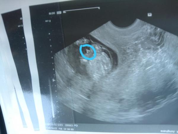 Bild zu Geschlecht erkennen! - Schwanger - wer noch? Rund um die Schwangerschaft