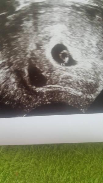 Bild zu Vielleicht kann mir jemand helfen - Schwanger - wer noch? Rund um die Schwangerschaft