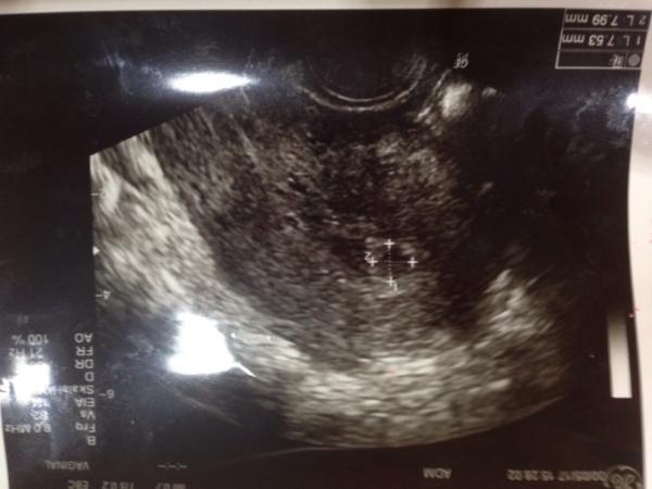 Bild zu blut in der gebärmutter - Schwanger - wer noch? Rund um die Schwangerschaft