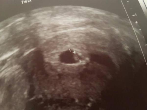 Bild zu 2. leere Fruchthülle - Schwanger - wer noch? Rund um die Schwangerschaft