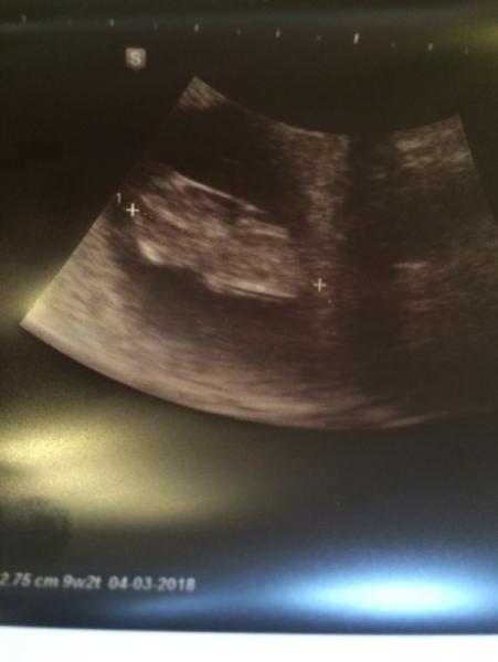 Bild zu Foto bewerten, 9+ keine arme und Beine zu erkennen?! - Schwanger - wer noch? Rund um die Schwangerschaft