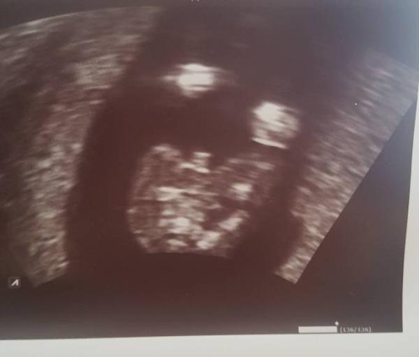 Bild zu ultraschallbild auswerten, hilfe :) - Schwanger - wer noch? Rund um die Schwangerschaft