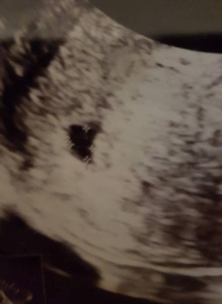 Bild zu Ab wann kann ich eine Elss aus schließen - Schwanger - wer noch? Rund um die Schwangerschaft