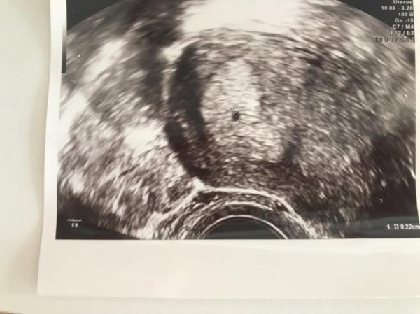 Bild zu Erste Schwangerschaft, einige Unsicherheiten - Schwanger - wer noch? Rund um die Schwangerschaft