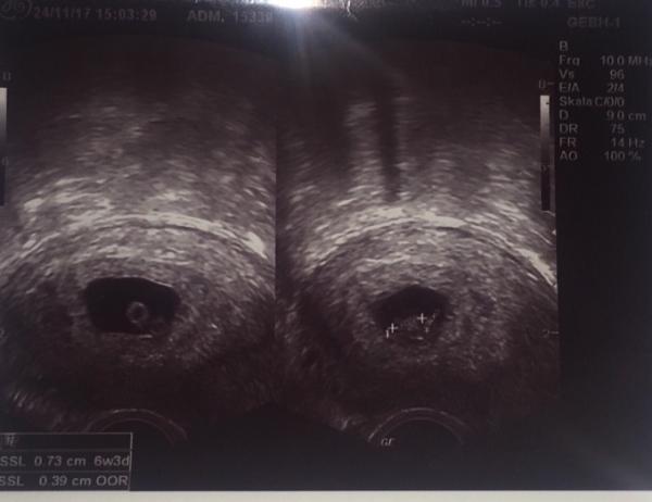 Bild zu Eineiige Zwillinge... - Schwanger - wer noch? Rund um die Schwangerschaft