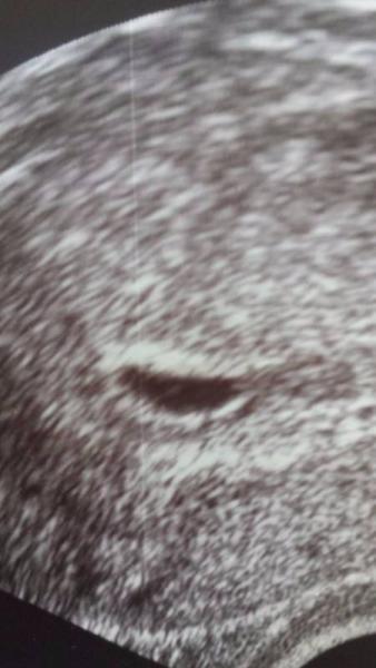 Bild zu Windei Ja oder Nein - Schwanger - wer noch? Rund um die Schwangerschaft