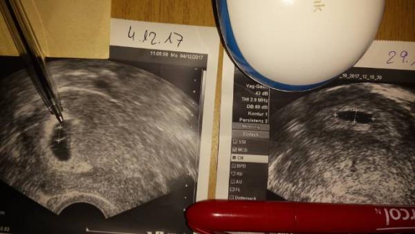 Bild zu FG ja oder nein - Schwanger - wer noch? Rund um die Schwangerschaft