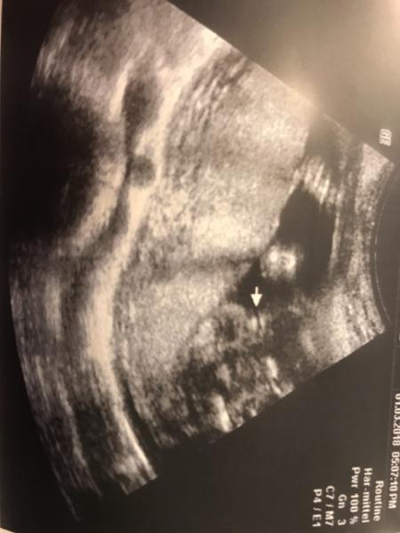 Bild zu Sicheres Outing? - Schwanger - wer noch? Rund um die Schwangerschaft