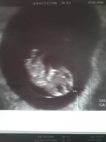 Bild zu Angst nach Ultraschall - Schwanger - wer noch? Rund um die Schwangerschaft