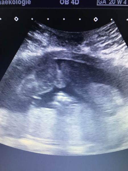 Bild zu 2.großes Ultraschall+Outing - Schwanger - wer noch? Rund um die Schwangerschaft