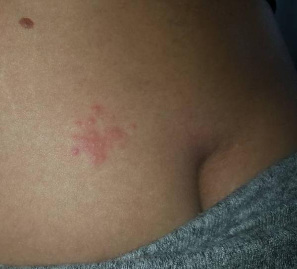 Bild zu 23.ssw Rücken-/ Hautschmerzen mit Pusteln - Schwanger - wer noch? Rund um die Schwangerschaft