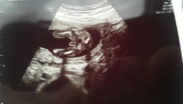 Bild zu JUNGE oder MÄDCHEN?? - Schwanger - wer noch? Rund um die Schwangerschaft