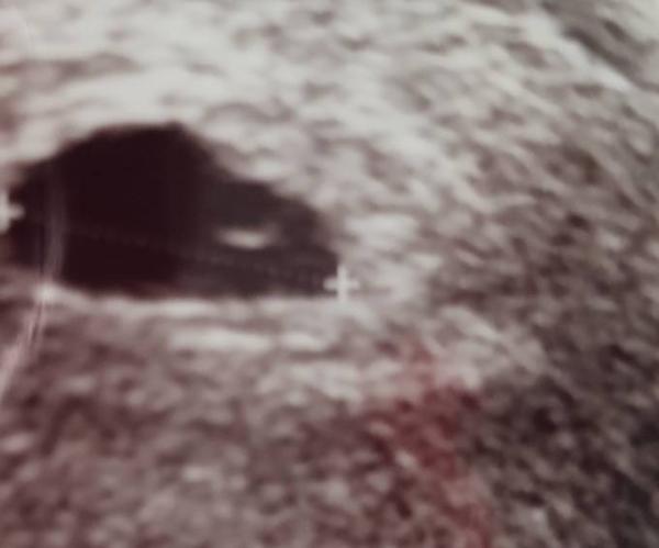 Bild zu Schwanger nach 1 icsi - Schwanger - wer noch? Rund um die Schwangerschaft