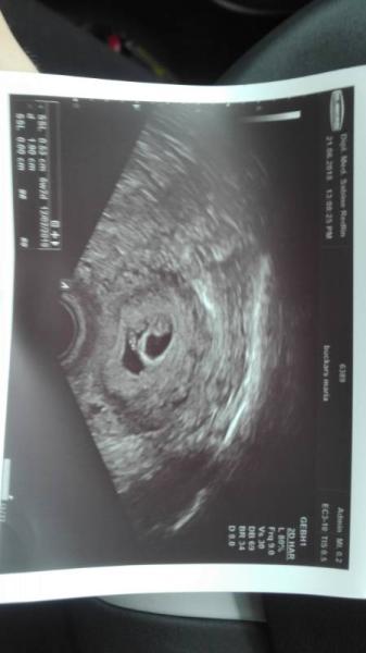 Bild zu Dottersack ohne Embryo (6+3) - Schwanger - wer noch? Rund um die Schwangerschaft