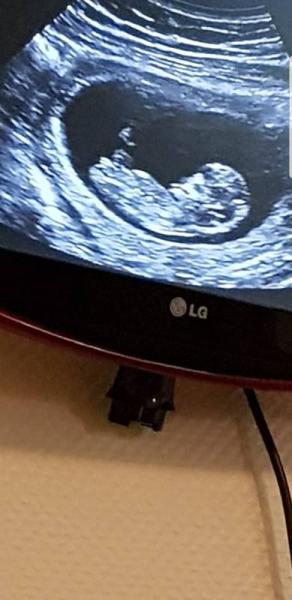 Bild zu Hallo liebe Mädels was denkt ihr was es wird - Schwanger - wer noch? Rund um die Schwangerschaft