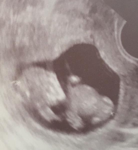 Bild zu Junge oder Mädchen - Schwanger - wer noch? Rund um die Schwangerschaft