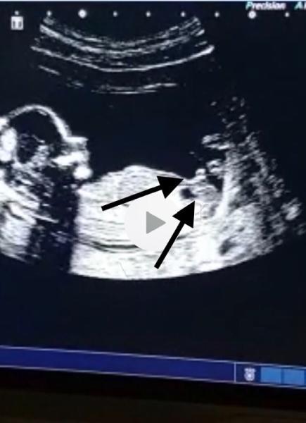 Bild zu Nub zu erkennen ? - Schwanger - wer noch? Rund um die Schwangerschaft