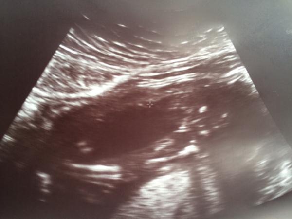 Bild zu Mädchen oder Junge? :) - Schwanger - wer noch? Rund um die Schwangerschaft