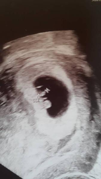 Bild zu Embryo zu klein und kein herzschlag. Bitte um Erfahrung oder rat - Schwanger - wer noch? Rund um die Schwangerschaft