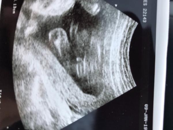 Bild zu 23 SSW Geschlecht erkennen! - Schwanger - wer noch? Rund um die Schwangerschaft