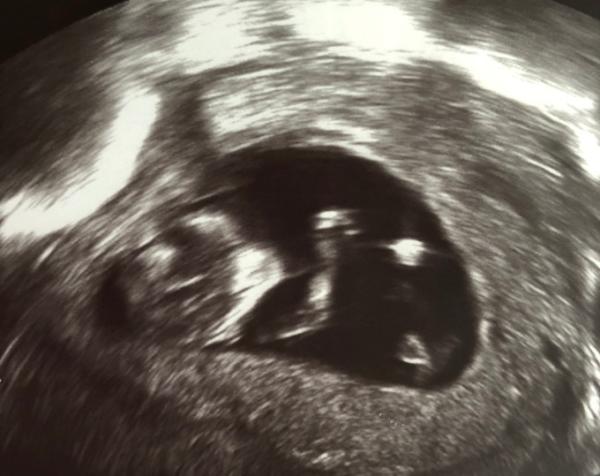 Bild zu Schwanger mit 19 - Schwanger - wer noch? Rund um die Schwangerschaft