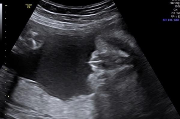 Bild zu 28 ssw klitoris im Ultraschall so dick/normal? - Schwanger - wer noch? Rund um die Schwangerschaft