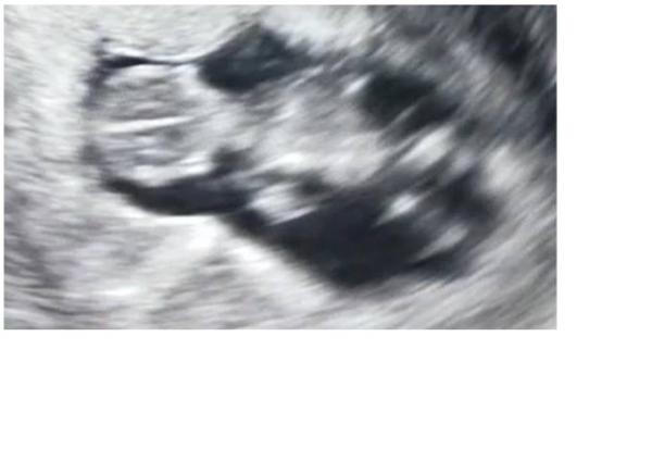 Bild zu Praenatest besser als Fruchtwasseruntersuchung - Schwanger - wer noch? Rund um die Schwangerschaft