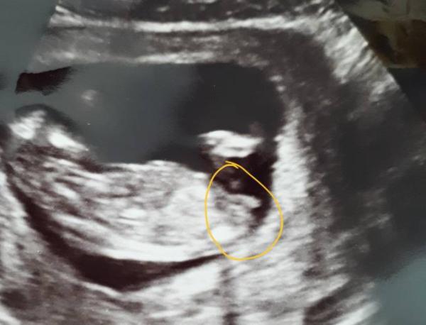 Bild zu Mädchen oder Junge? 13+3 - Schwanger - wer noch? Rund um die Schwangerschaft