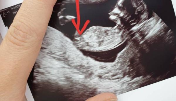Bild zu NUB? - Schwanger - wer noch? Rund um die Schwangerschaft