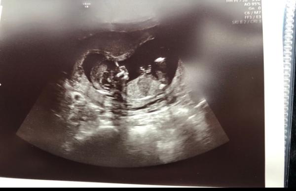 Bild zu Geschlecht Baby - Schwanger - wer noch? Rund um die Schwangerschaft